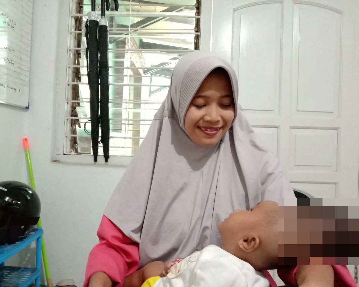 Ainun kecil menderita Ensephalocele Unspesific