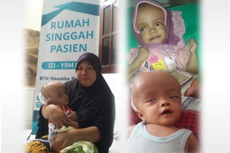 Azizah Hydrocephalus